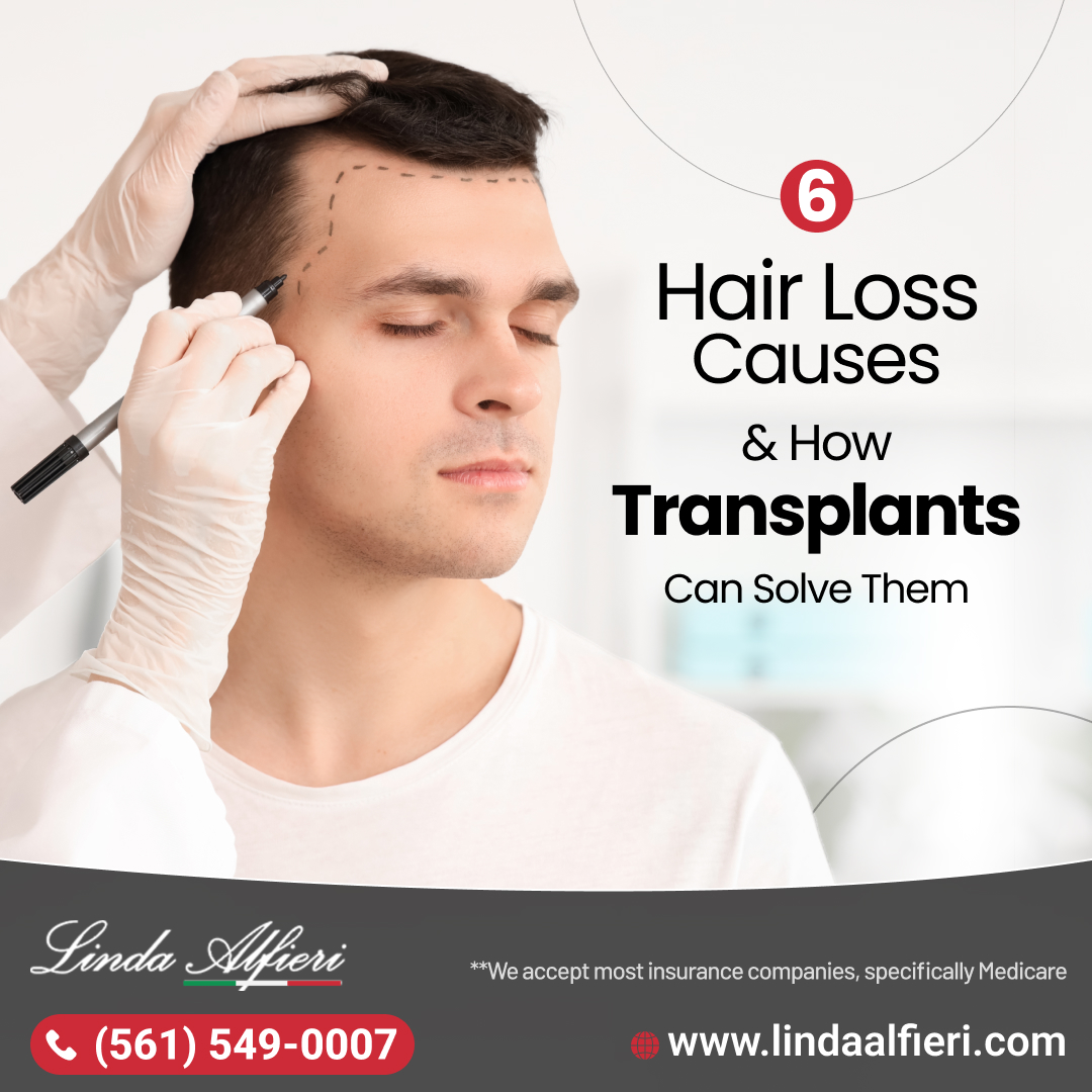 hair transplant in Boca Raton